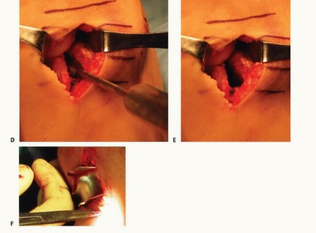 Illustration 15 for Symptomatic Knee? Meniscal Transplant for Anterior & Posterior Horns
