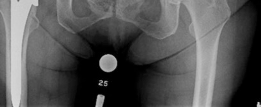 Illustration 9 for Primary Uncemented Total Hip Arthroplasty: A Case Study Title