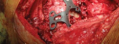 Illustration 31 for Optimizing Arthroplasty in Acute Fractures: Octopus System