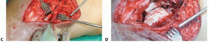 Illustration 46 for Repairing Distal Femur Fractures: Open Reduction & Internal Fixation