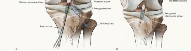 Illustration 22 for Optimizing ACL Reconstruction for Skeletally Immature Patients