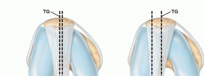 Solving Stubborn Knee Pain: Tibial Tubercle Transfer Explained