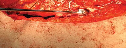 Illustration 101 for Femoral Stem Revision: Posterior Approach for Better Outcomes
