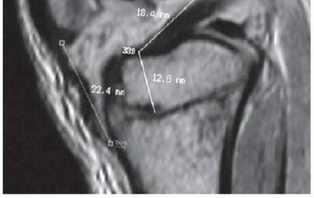 Illustration 2 for Optimizing ACL Reconstruction for Skeletally Immature Patients