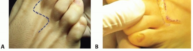 Illustration 14 for Plantar Plate Repair: End Lesser Toe Pain & Instability
