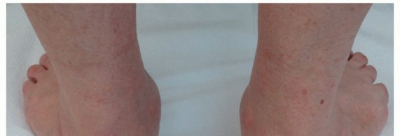 Lateral Column Lengthening: Relieve Flatfoot Pain & Correct Deformity