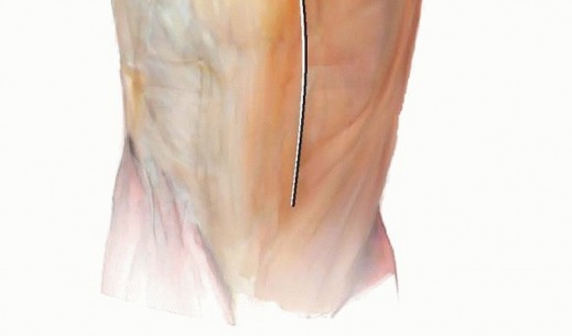 Illustration 8 for Achieve Lasting Pain Relief with Cemented Total Knee Arthroplasty