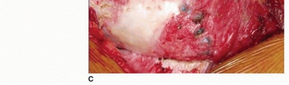 Illustration 33 for Allograft Prosthetic Composite: Mastering Proximal Femur Reconstruction