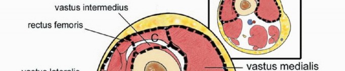 Illustration 2 for Limb-Sparing Quadriceps Resection: Superficial Femoral Artery