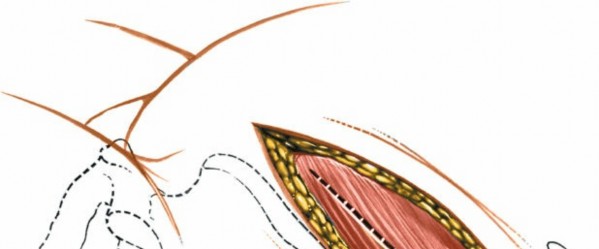 Illustration 9 for Master the Anterolateral Retroperitoneal Approach to Lumbar Spine