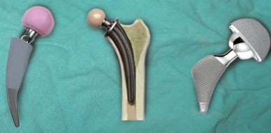 Illustration 55 for Mastering Hip Arthroplasty: Its Evolution and Design Unveiled