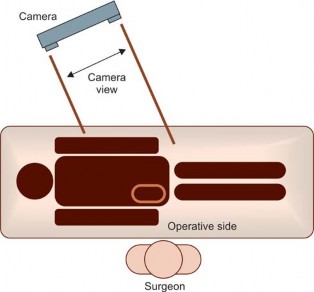 Illustration 19 for Minimizing Risks: Computer Navigation in Hip Resurfacing Arthroplasty