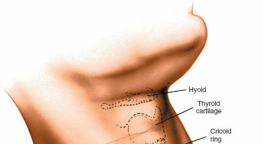 Illustration 3 for Mastering the Anterior Cervical Approach: Longus Colli Muscle Insights