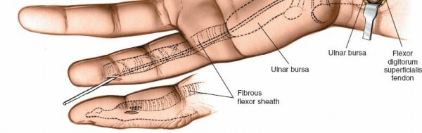 Illustration 8 for Surgical Secrets: Anatomy of the Deep Palmar Space Revealed