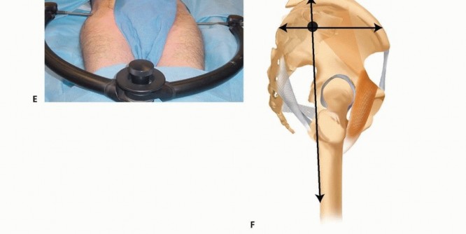 Illustration 32 for Emergency Fixation of the Pelvis: Control Bleeding & Restore Stability