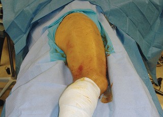 Illustration 8 for Unlock the Figure Posterior Approach to the Hip