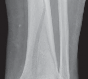 Illustration 39 for Optimizing ORIF for Tibial Plafond Fractures: A Modern Approach