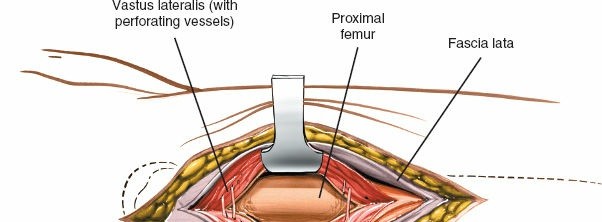 Illustration 9 for Optimal Femoral Approaches: Mastering the Lateral Intermuscular Septum
