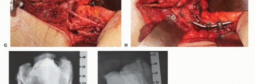Illustration 54 for Sacral Tumor Surgery: Safeguarding Bowel & Bladder Control