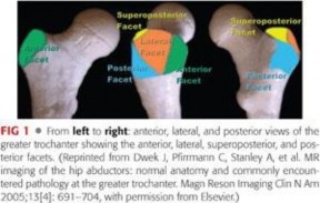 Illustration 12 for Periarticular Arthroscopy: Addressing Medius & Minimus Tears