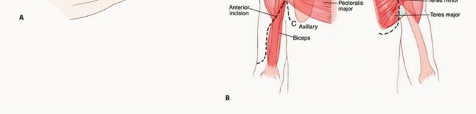 Illustration 8 for Mastering Total Scapular Resections: Reconstruction & Outcomes