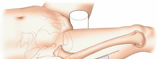 Illustration 66 for Optimal Femoral Approaches: Mastering the Lateral Intermuscular Septum
