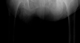Illustration 11 for Mastering Direct Anterior Approach Hip Arthroplasty Without a Traction Table