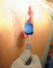 Illustration 24 for Knee Arthroplasty Unicondylar: Discover if Partial Knee Replacement is Right