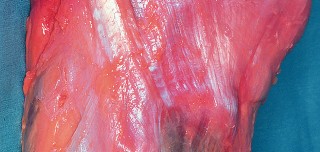 Illustration 24 for Mastering Valgus Total Knee Replacement: Techniques & Pitfalls