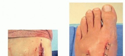 Illustration 26 for Fixation of Lisfranc Injuries: Essential Open Reduction Guide