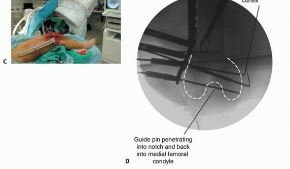 Illustration 36 for Repairing Distal Femur Fractures: Open Reduction & Internal Fixation