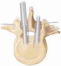Illustration 22 for Optimizing Instrumentation for Neuromuscular Scoliosis