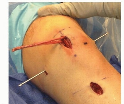 Illustration 12 for Chronic Patellar Instability: From Acute Onset to Lasting Solutions