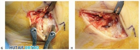 Illustration 56 for Medial Ankle Instability: Find Relief with Reconstruction