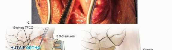 Illustration 15 for Galeazzi DRUJ Stabilization: Unlocking Stability with Smooth Stainless Steel