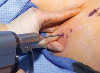 Illustration 7 for Avoiding Errors: Navigation in Total Hip Arthroplasty