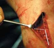 Illustration 41 for Guide Pin Assembly: Key to Flawless Upper Tibial Osteotomy