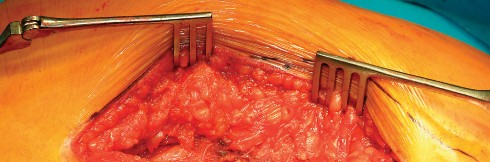 Illustration 66 for Direct Lateral Hip: Optimize Exposure with Sharp Curved Hohmann