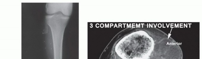 Illustration 7 for Mastering Above-Knee Amputation: Essential Surgical Insights