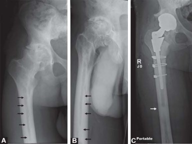 Illustration 2 for Maximize Success: Preoperative planning in primary Hip Replacement