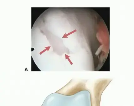 صورة توضيحية لـ الترقيع الدقيق للغضروف (Microfracture): حلول مبتكرة لآلام الركبة في اليمن