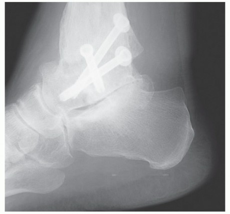Isolated Subtalar Arthrodesis: When & Why It's Preferred