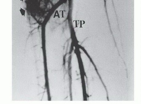 Illustration 12 for Tackling Complex Tumors of the Proximal Tibia: Limb-Sparing Solutions