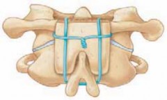 Illustration 22 for Cervical Fusion: The Line is Drawn for Lasting Stability