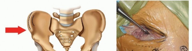Illustration 14 for Emergency Fixation of the Pelvis: Control Bleeding & Restore Stability
