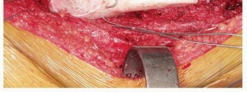 Illustration 12 for Allograft Prosthetic Composite: Mastering Proximal Femur Reconstruction