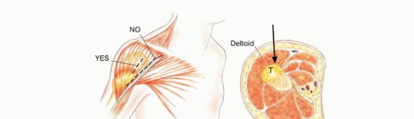 Illustration 33 for Precision Biopsy of Musculoskeletal Tumors for Accurate Diagnosis