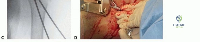 Illustration of percutaneous pinning for proximal - Dr. Mohammed Hutaif