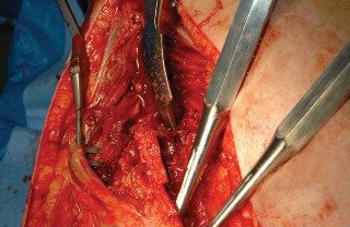 Illustration 77 for Femoral Stem Revision: Posterior Approach for Better Outcomes