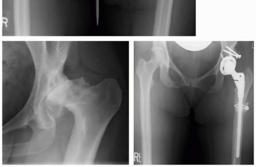 Illustration 2 for Mastering Femoral Head Autograft in DDH Hip Reconstruction